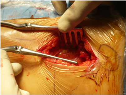Operazione di protesi all'anca