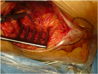 Protesi all'anca - operazione chirurgica