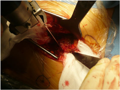 Asportazione della testa femorale in protesi d'anca