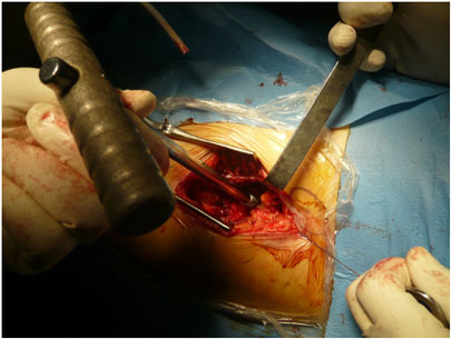 Asportazione della testa femorale in operazione di protesi d'anca