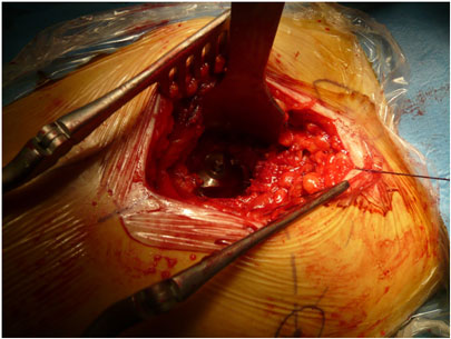 Protesi all'anca - operazione chirurgica