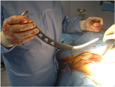 Preparazione del femore: operazione di protesi d'anca