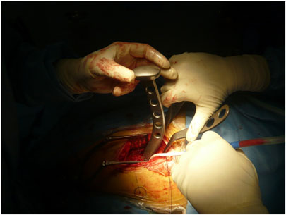 Operazione chirurgica di protesi all'anca