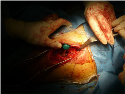 Protesi all'anca, operazione chirurgica