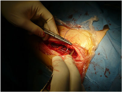 Intervento di protesi d'anca - Sutura