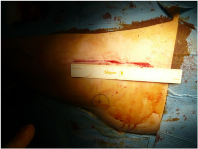 Sutura - intervento di protesi d'anca