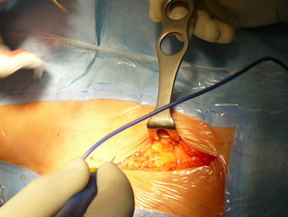 Dissezione superficiale per protesi dell'anca