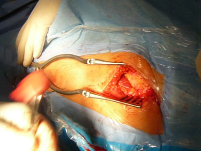 Dissezione superficiale in un'operazione di protesi dell'anca