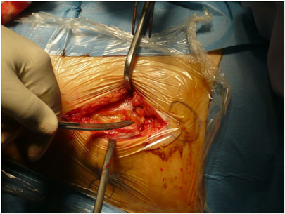 Protesi all'anca - dissezione profonda