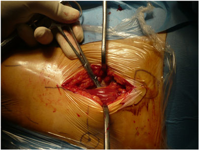 Operazione di protesi dell'anca - Dissezione profonda